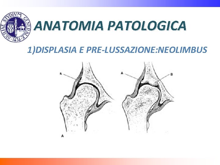 ANATOMIA PATOLOGICA 1)DISPLASIA E PRE-LUSSAZIONE: NEOLIMBUS 