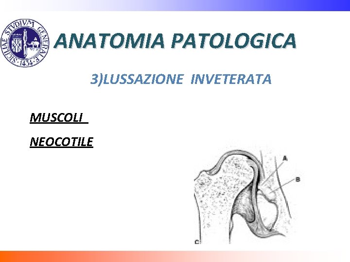 ANATOMIA PATOLOGICA 3)LUSSAZIONE INVETERATA MUSCOLI NEOCOTILE 