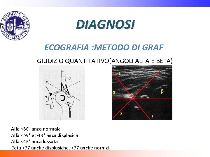 DIAGNOSI ECOGRAFIA : METODO DI GRAF GIUDIZIO QUANTITATIVO(ANGOLI ALFA E BETA) Alfa >60° anca