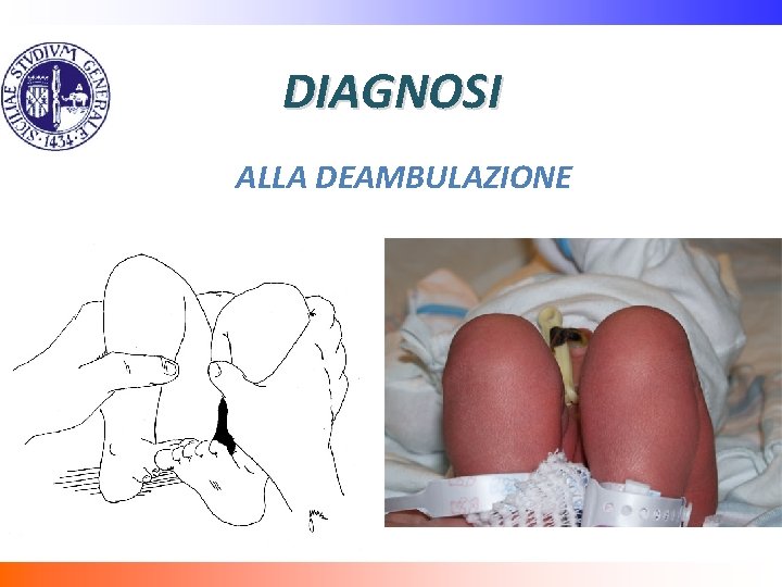 DIAGNOSI ALLA DEAMBULAZIONE 