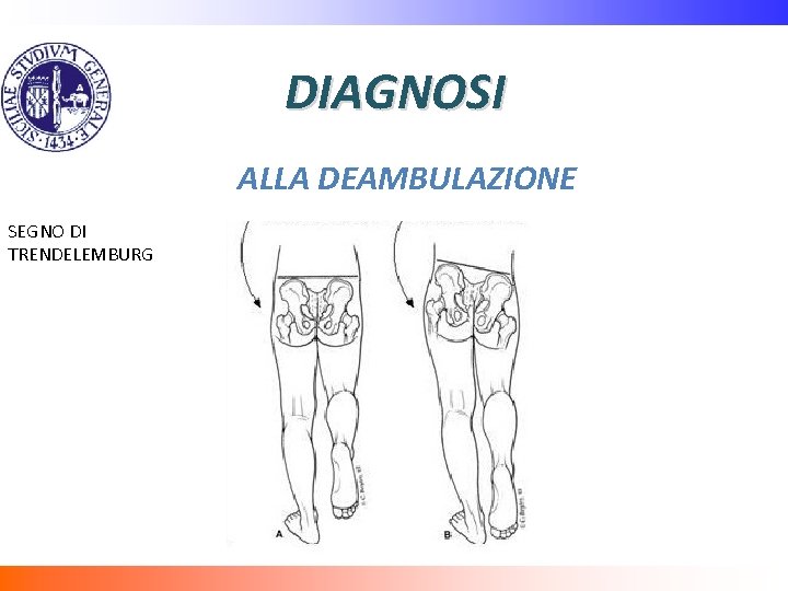 DIAGNOSI ALLA DEAMBULAZIONE SEGNO DI TRENDELEMBURG 