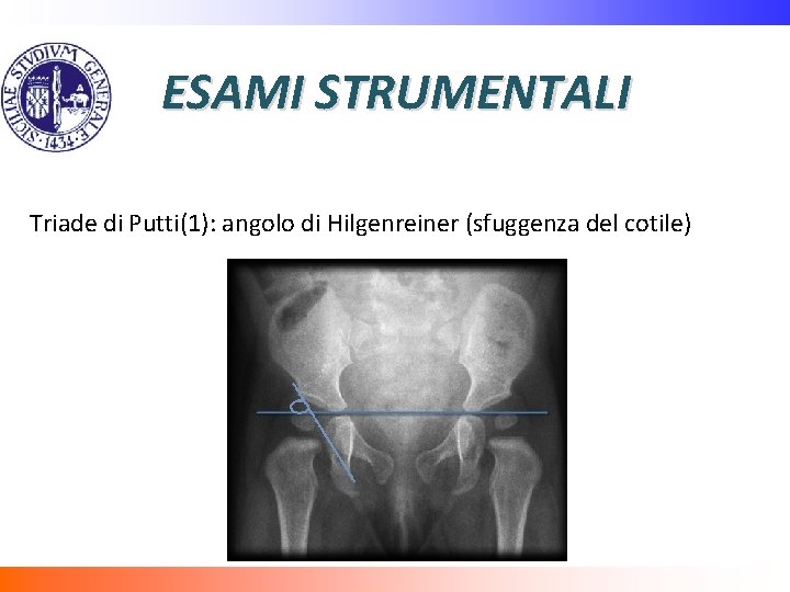 ESAMI STRUMENTALI Triade di Putti(1): angolo di Hilgenreiner (sfuggenza del cotile) 