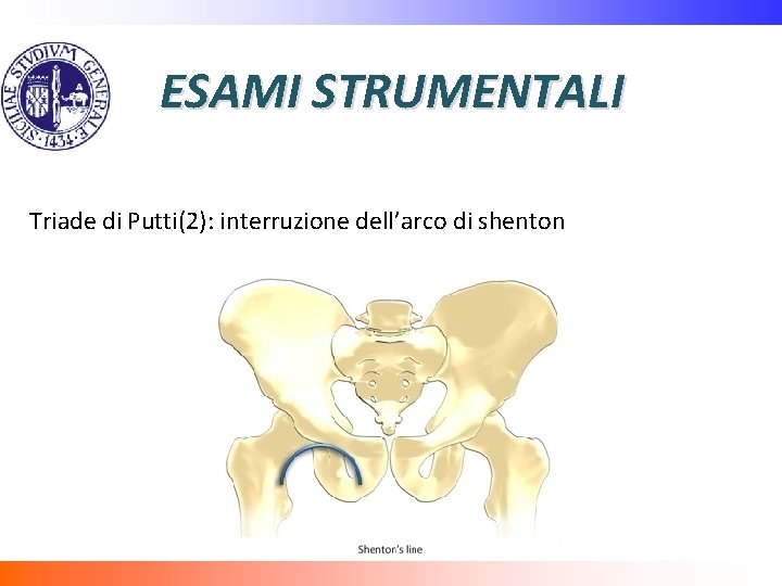 ESAMI STRUMENTALI Triade di Putti(2): interruzione dell’arco di shenton 