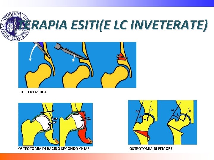 TERAPIA ESITI(E LC INVETERATE) TETTOPLASTICA OSTEOTOMIA DI BACINO SECONDO CHIARI OSTEOTOMIA DI FEMORE 