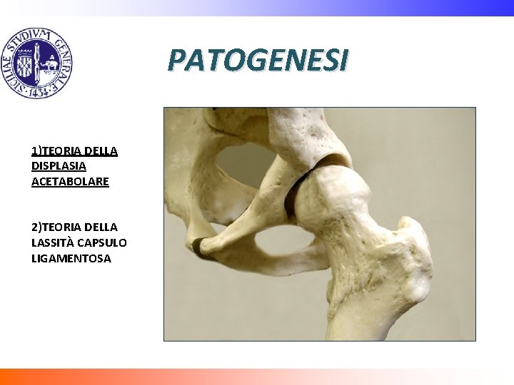 PATOGENESI 1)TEORIA DELLA DISPLASIA ACETABOLARE 2)TEORIA DELLA LASSITÀ CAPSULO LIGAMENTOSA 