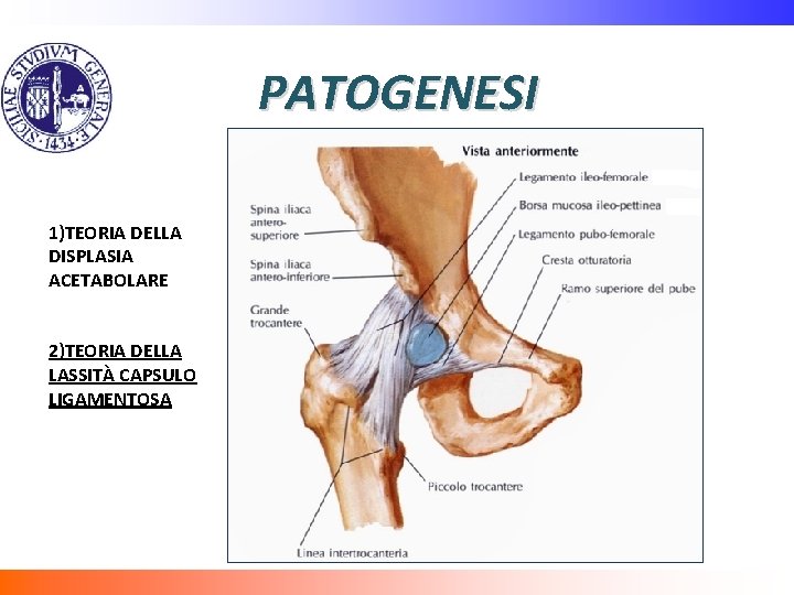 PATOGENESI 1)TEORIA DELLA DISPLASIA ACETABOLARE 2)TEORIA DELLA LASSITÀ CAPSULO LIGAMENTOSA 