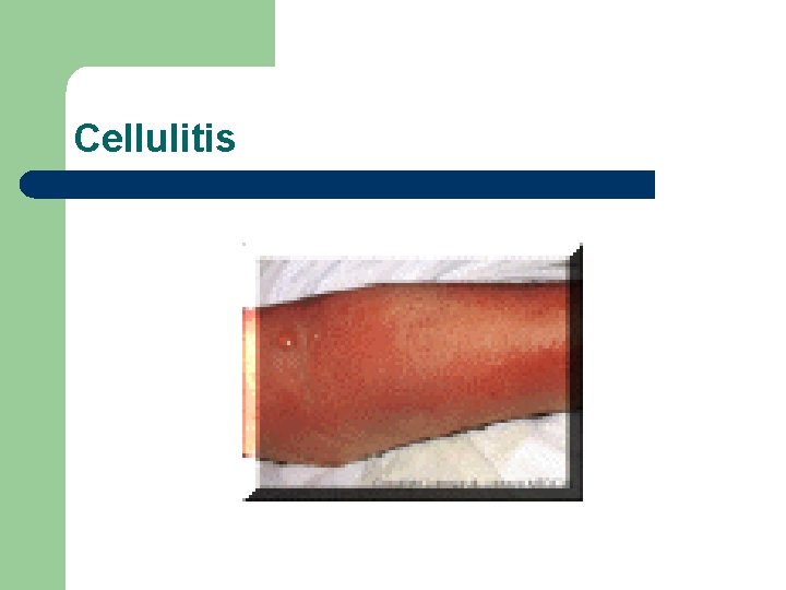 Cellulitis 