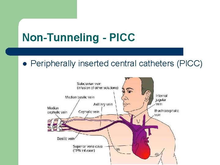 Non-Tunneling - PICC l Peripherally inserted central catheters (PICC) 