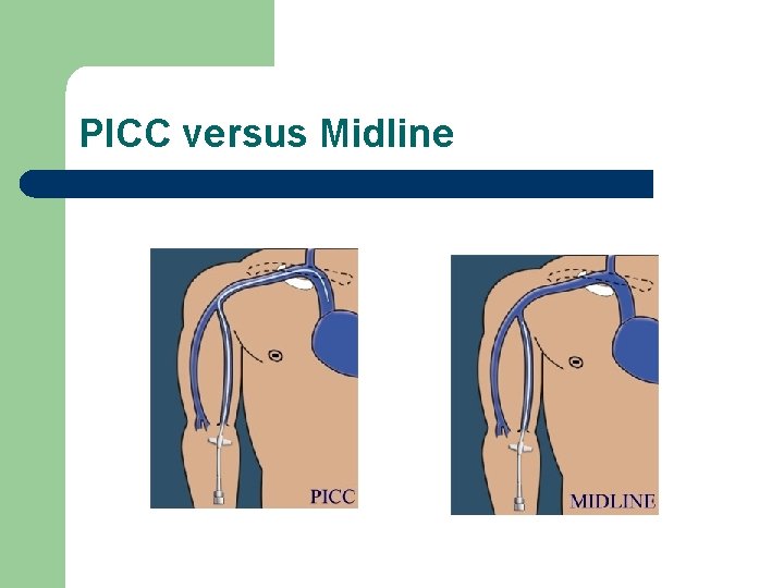PICC versus Midline 