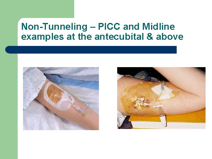 Non-Tunneling – PICC and Midline examples at the antecubital & above 