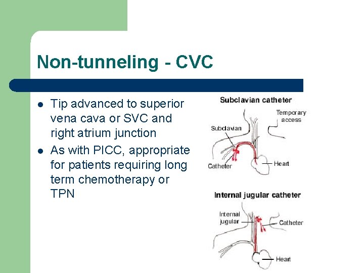 Non-tunneling - CVC l l Tip advanced to superior vena cava or SVC and