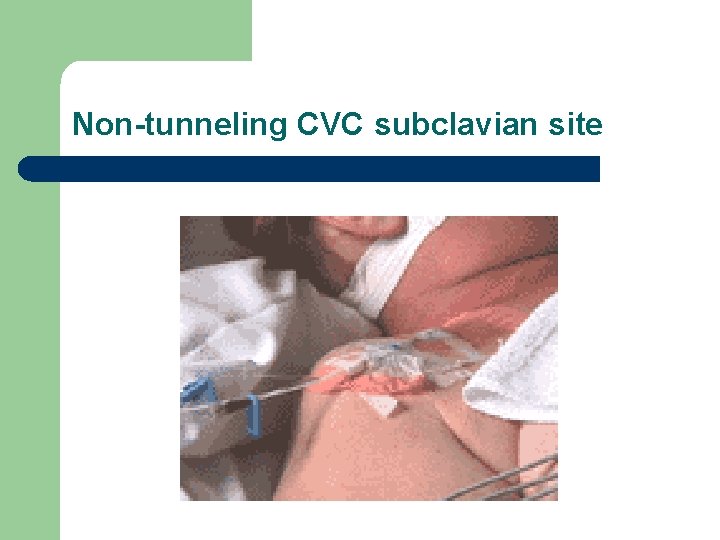 Non-tunneling CVC subclavian site 