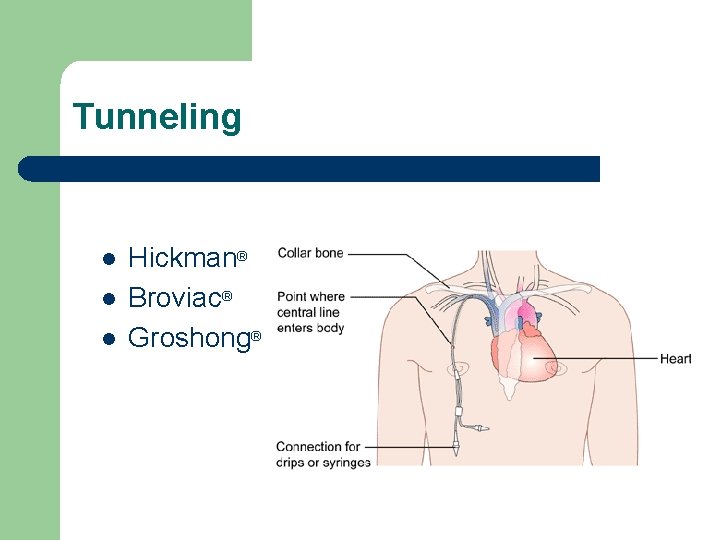 Tunneling l l l Hickman® Broviac® Groshong® 
