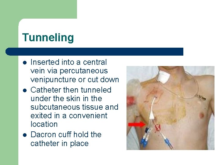 Tunneling l l l Inserted into a central vein via percutaneous venipuncture or cut