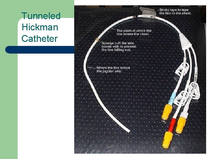 Tunneled Hickman Catheter 