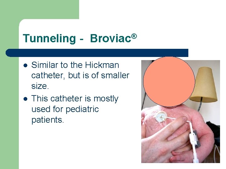 Tunneling - Broviac® l l Similar to the Hickman catheter, but is of smaller