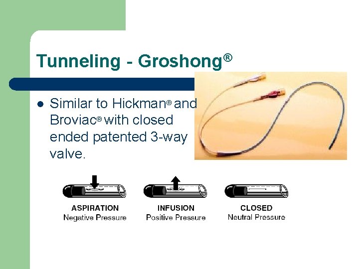 Tunneling - Groshong® l Similar to Hickman® and Broviac® with closed ended patented 3