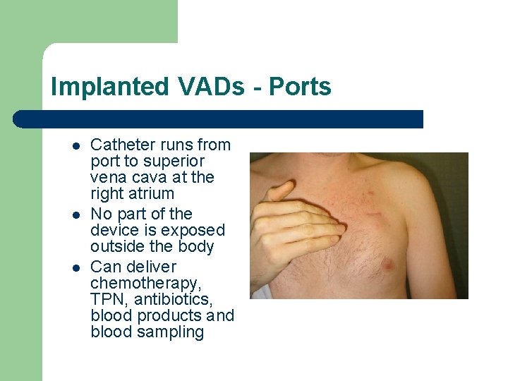 Implanted VADs - Ports l l l Catheter runs from port to superior vena