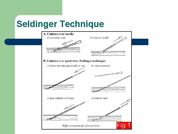 Seldinger Technique 