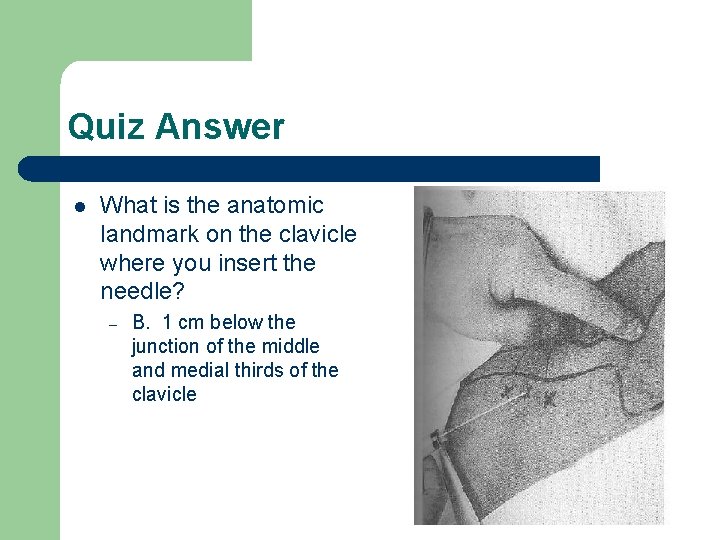 Quiz Answer l What is the anatomic landmark on the clavicle where you insert