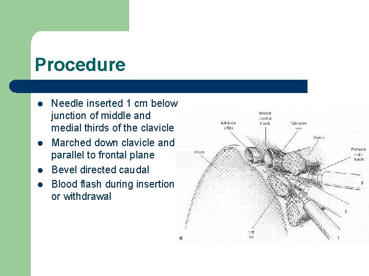 Procedure l l Needle inserted 1 cm below junction of middle and medial thirds