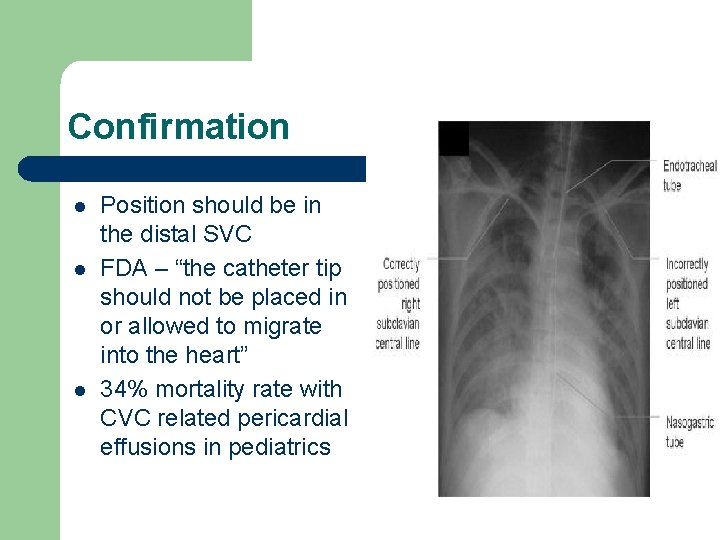Confirmation l l l Position should be in the distal SVC FDA – “the