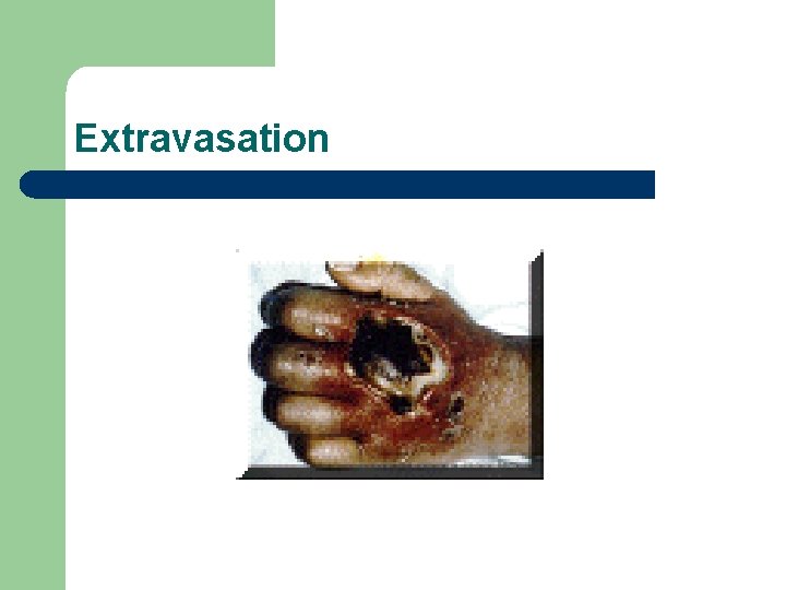 Extravasation 
