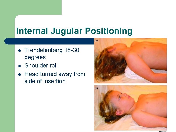 Internal Jugular Positioning l l l Trendelenberg 15 -30 degrees Shoulder roll Head turned