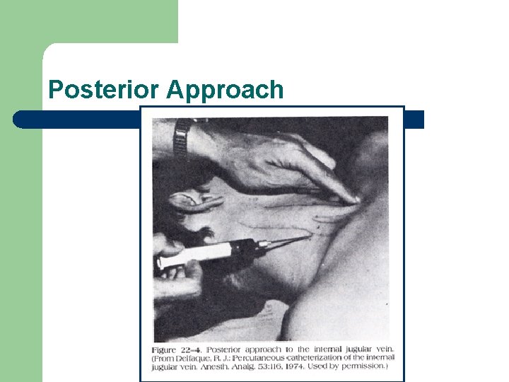 Posterior Approach 
