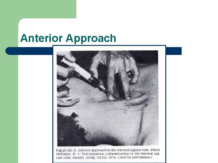 Anterior Approach 