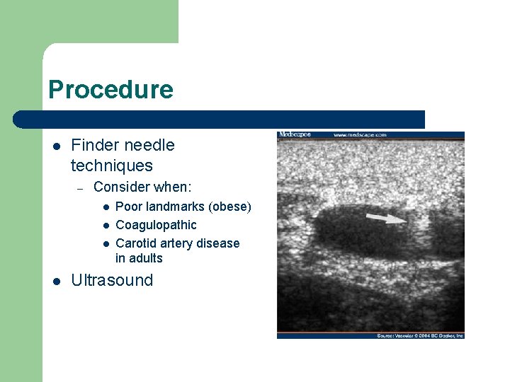 Procedure l Finder needle techniques – Consider when: l l Poor landmarks (obese) Coagulopathic