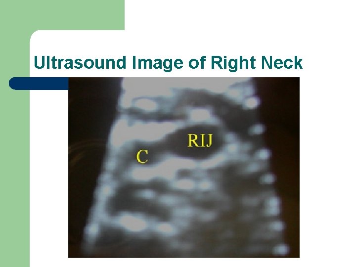 Ultrasound Image of Right Neck 