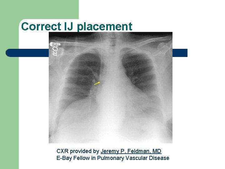 Correct IJ placement CXR provided by Jeremy P. Feldman, MD E-Bay Fellow in Pulmonary