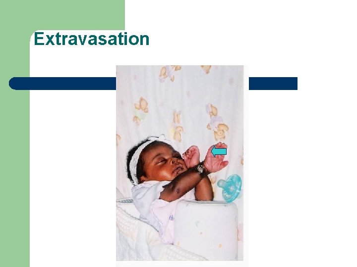 Extravasation 