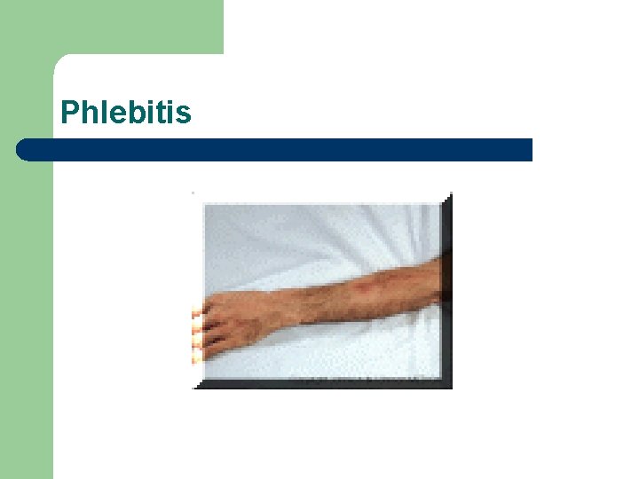 Phlebitis 