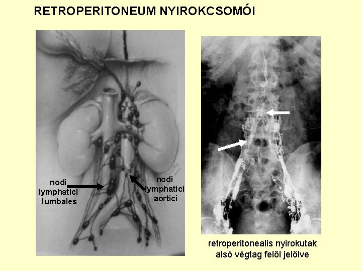 RETROPERITONEUM NYIROKCSOMÓI nodi lymphatici lumbales nodi lymphatici aortici retroperitonealis nyirokutak alsó végtag felől jelölve