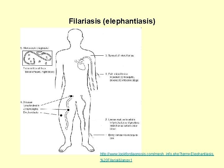 Filariasis (elephantiasis) http: //www. lookfordiagnosis. com/mesh_info. php? term=Elephantiasis, %20 Filarial&lang=1 