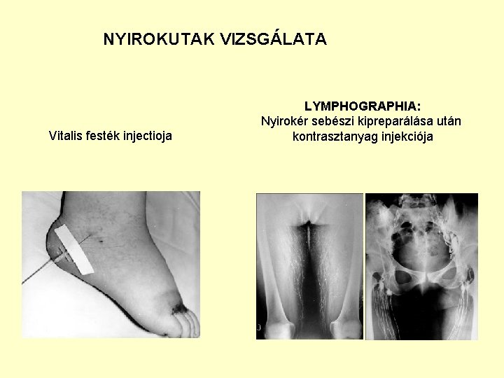 NYIROKUTAK VIZSGÁLATA Vitalis festék injectioja LYMPHOGRAPHIA: Nyirokér sebészi kipreparálása után kontrasztanyag injekciója 