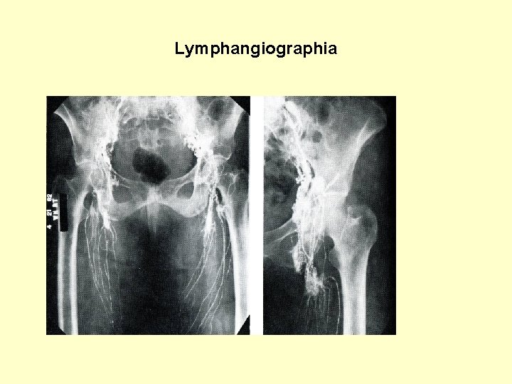 Lymphangiographia 