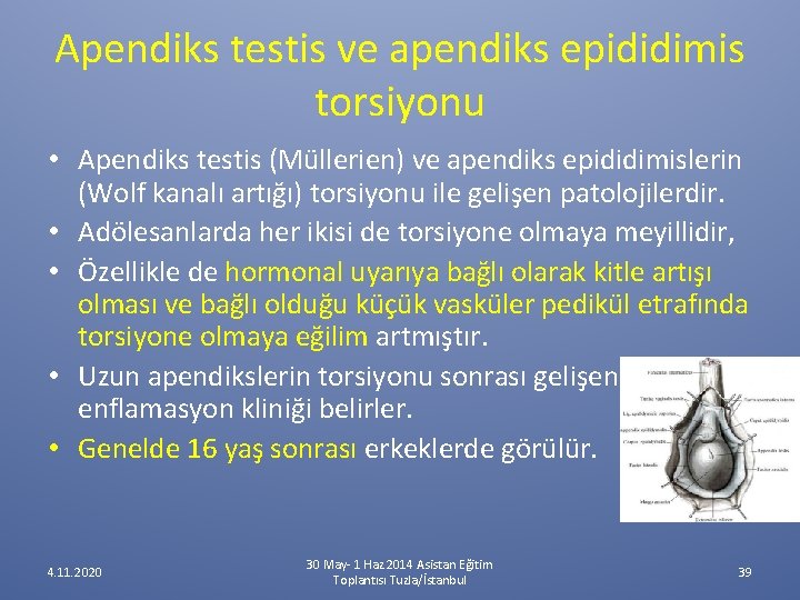 Apendiks testis ve apendiks epididimis torsiyonu • Apendiks testis (Müllerien) ve apendiks epididimislerin (Wolf Apendiks testis ve apendiks epididimis torsiyonu • Apendiks testis (Müllerien) ve apendiks epididimislerin (Wolf