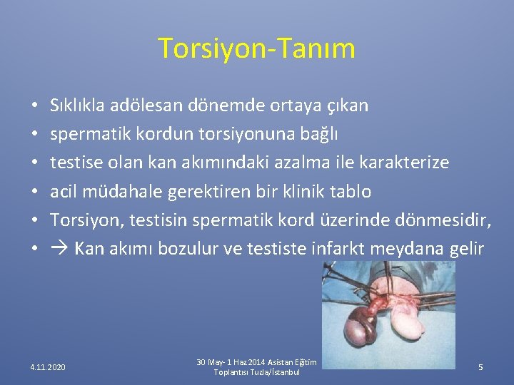 Torsiyon-Tanım • • • Sıklıkla adölesan dönemde ortaya çıkan spermatik kordun torsiyonuna bağlı testise Torsiyon-Tanım • • • Sıklıkla adölesan dönemde ortaya çıkan spermatik kordun torsiyonuna bağlı testise