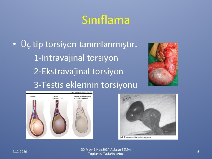 Sınıflama • Üç tip torsiyon tanımlanmıştır. 1 -Intravajinal torsiyon 2 -Ekstravajinal torsiyon 3 -Testis Sınıflama • Üç tip torsiyon tanımlanmıştır. 1 -Intravajinal torsiyon 2 -Ekstravajinal torsiyon 3 -Testis