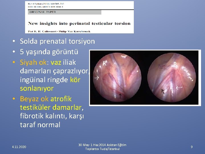 • Solda prenatal torsiyon • 5 yaşında görüntü • Siyah ok: vaz iliak • Solda prenatal torsiyon • 5 yaşında görüntü • Siyah ok: vaz iliak