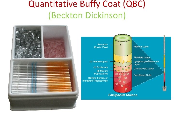 Quantitative Buffy Coat (QBC) (Beckton Dickinson) Quantitative Buffy Coat (QBC) (Beckton Dickinson)