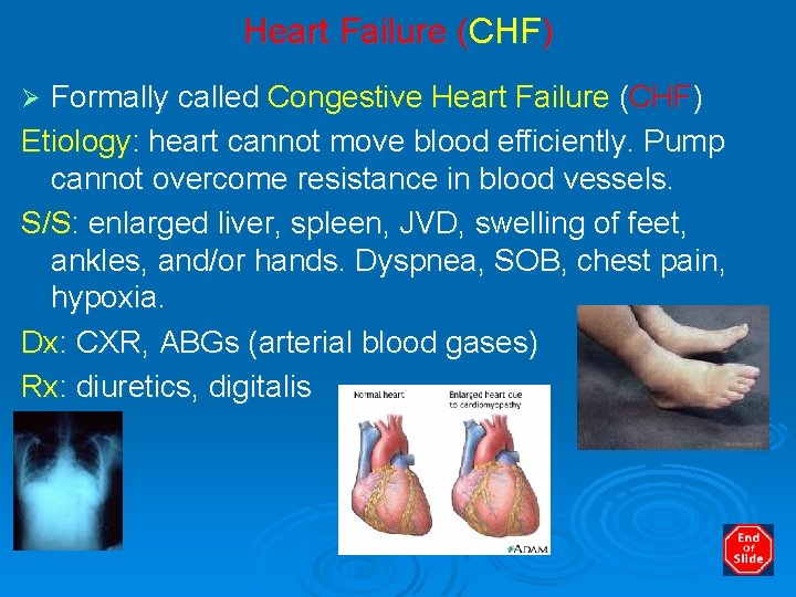 Heart Failure (CHF) Formally called Congestive Heart Failure (CHF) Etiology: heart cannot move blood