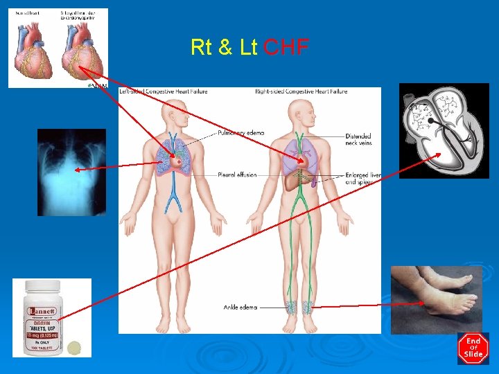 Rt & Lt CHF 