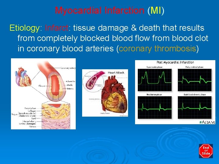 Myocardial Infarction (MI) Etiology: Infarct: tissue damage & death that results from completely blocked