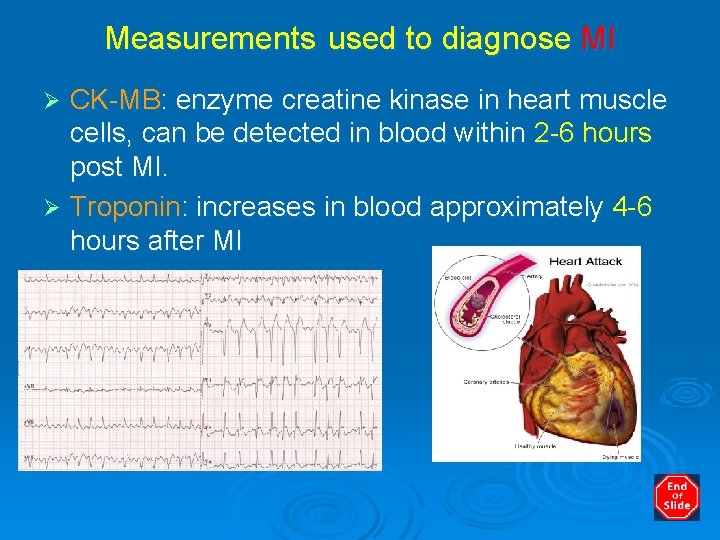 Measurements used to diagnose MI CK-MB: enzyme creatine kinase in heart muscle cells, can