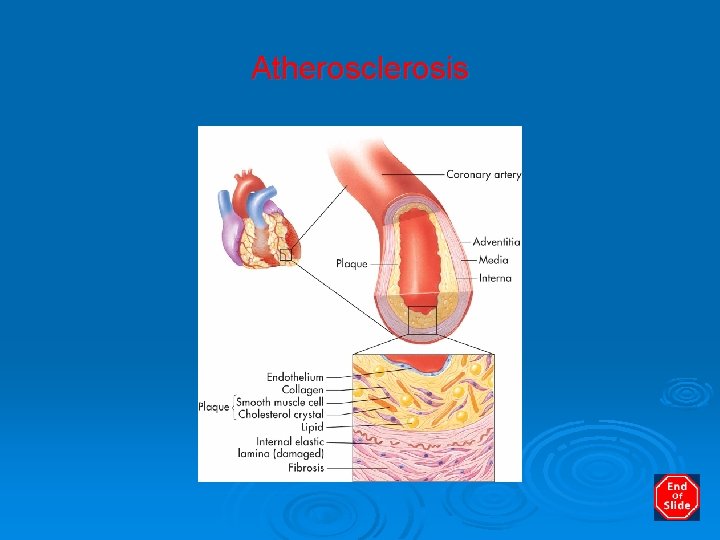 Atherosclerosis 