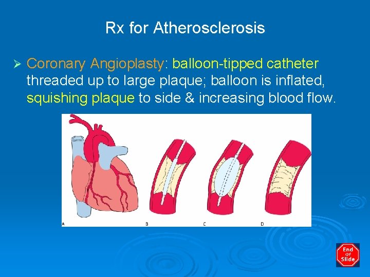 Rx for Atherosclerosis Ø Coronary Angioplasty: balloon-tipped catheter threaded up to large plaque; balloon